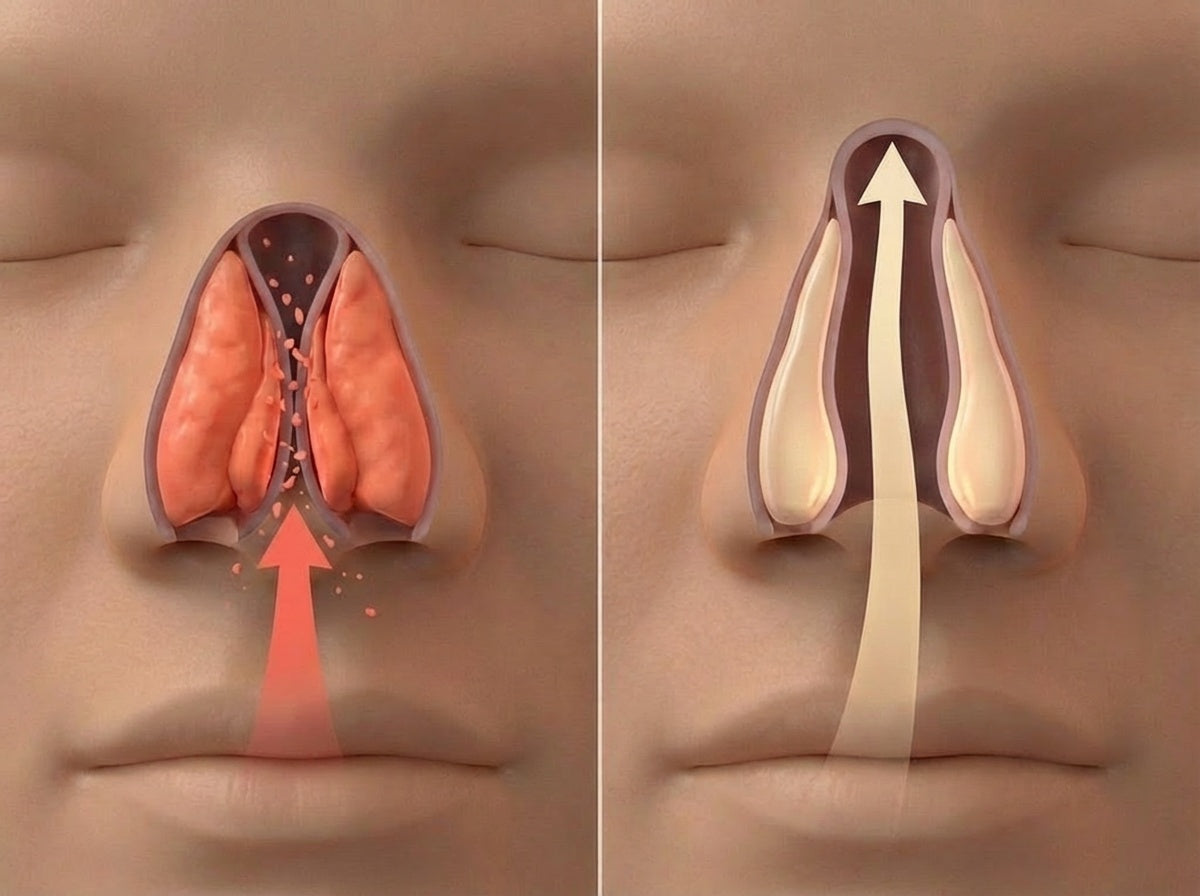 Frontal view of the nasal valve during sleep — left: collapsed tissue blocks airflow, right: open passage allows uninterrupted breathing